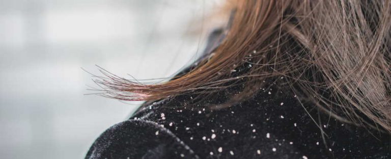 How to Treat Dandruff Naturally? | Art Farms